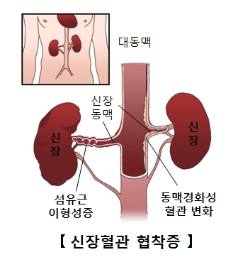 신동맥 협착증