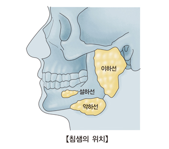 침샘염