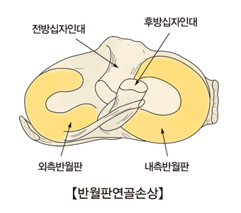 반달연골 이상