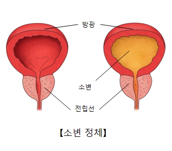 소변정체