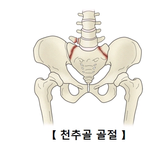 천추골 골절