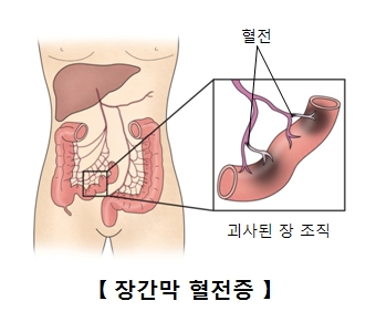 장간막 정맥 혈전증