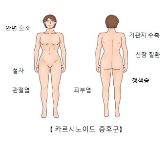 카르시노이드증후군