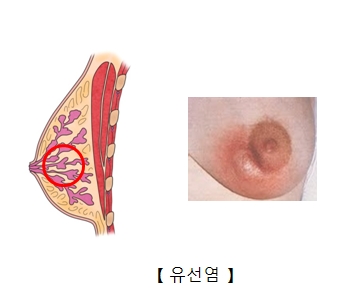 유방 농양