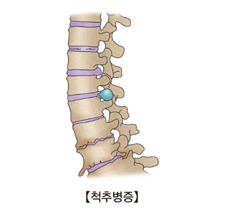 척추병증