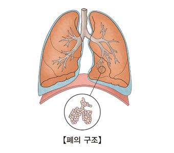 폐암