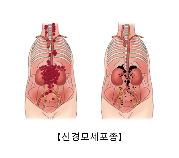 신경모세포종