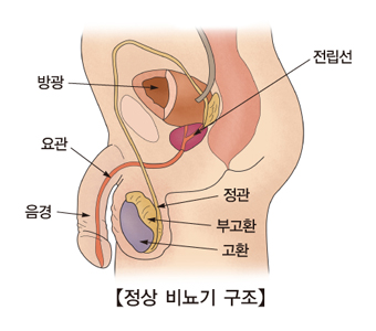 방광암