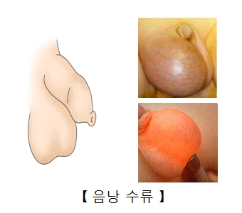 음낭수류