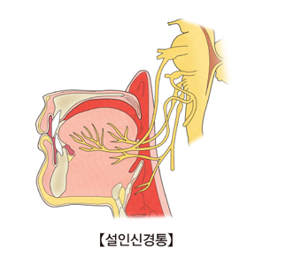 설인신경통