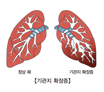 기관지확장증