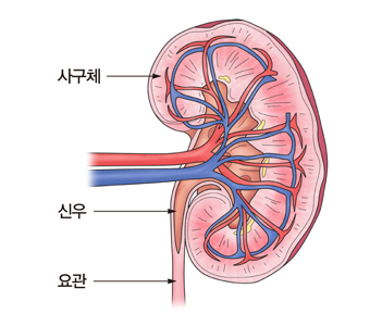 급성 신우신염