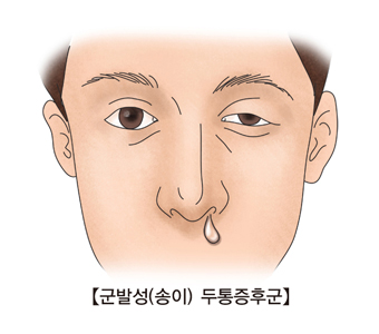 군발성 두통증후군