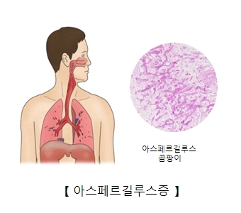 아스페르길루스증