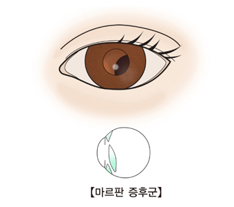 마르판 증후군