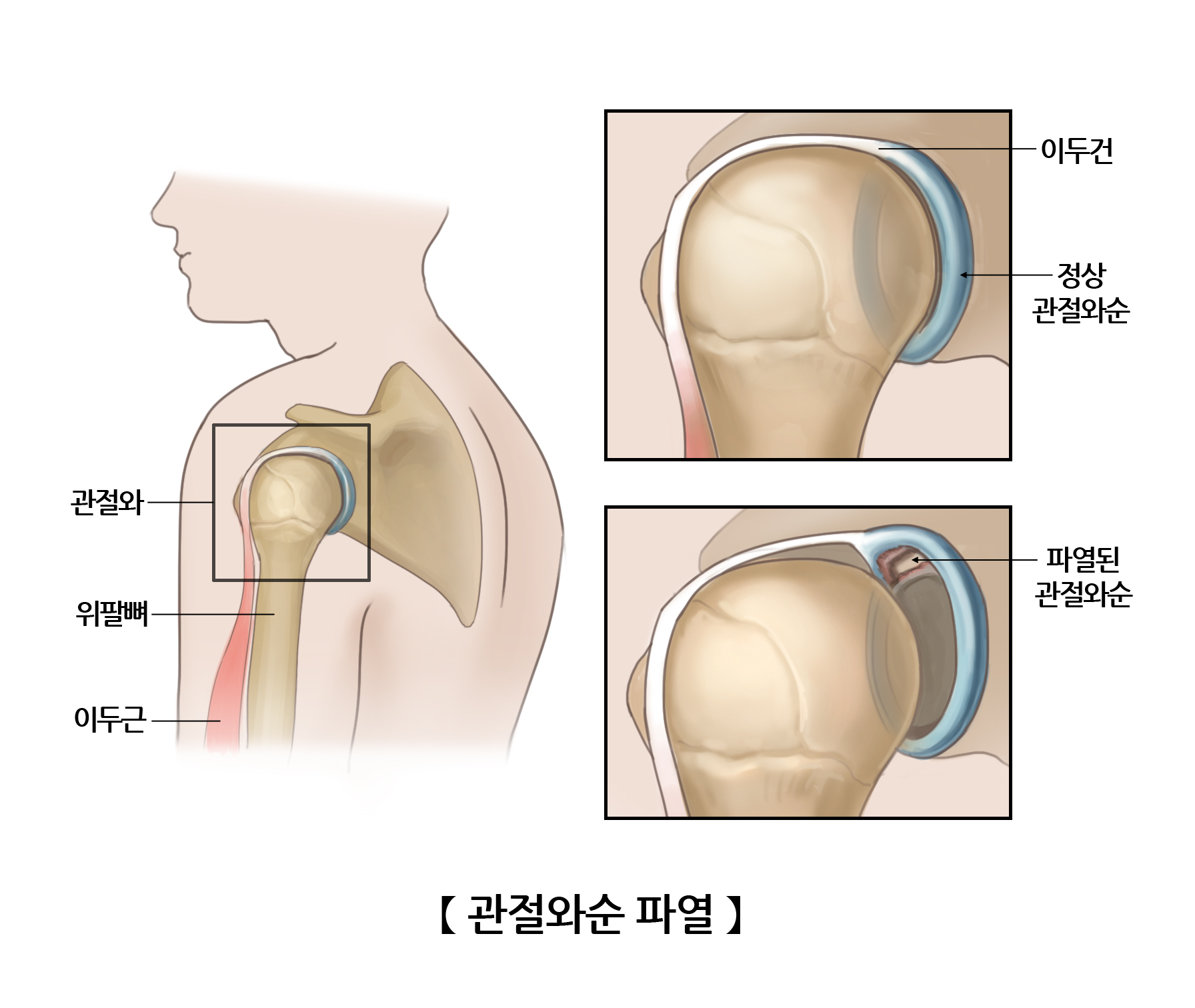 관절와순 파열 그림