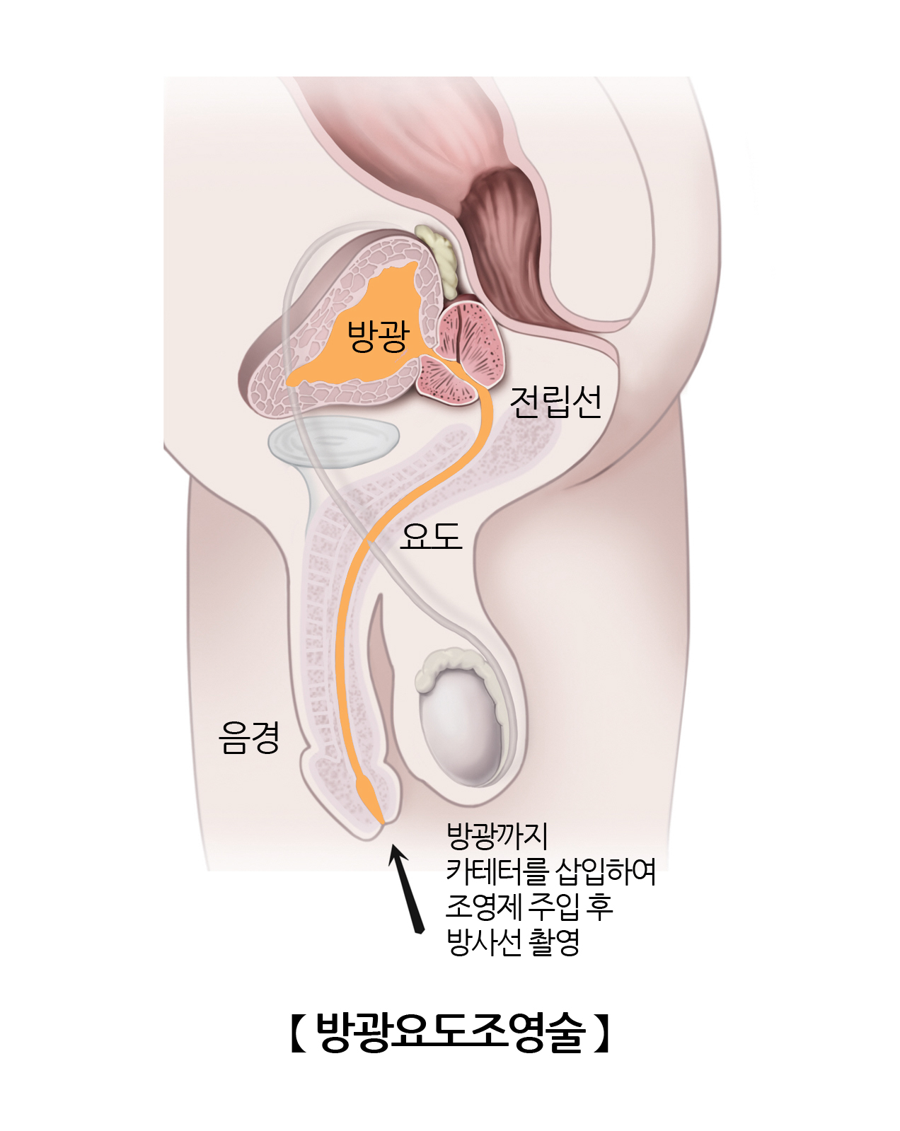 역행성 요도조영술