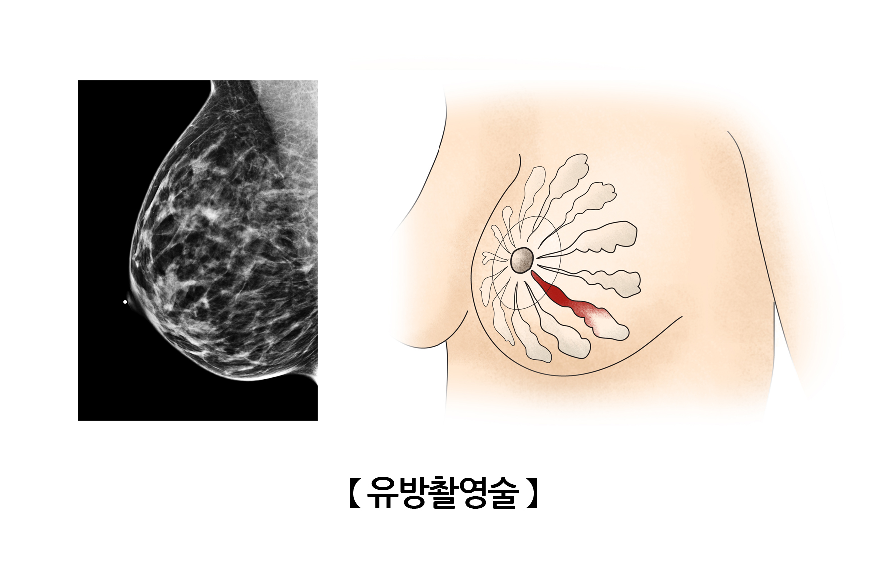 유방촬영술