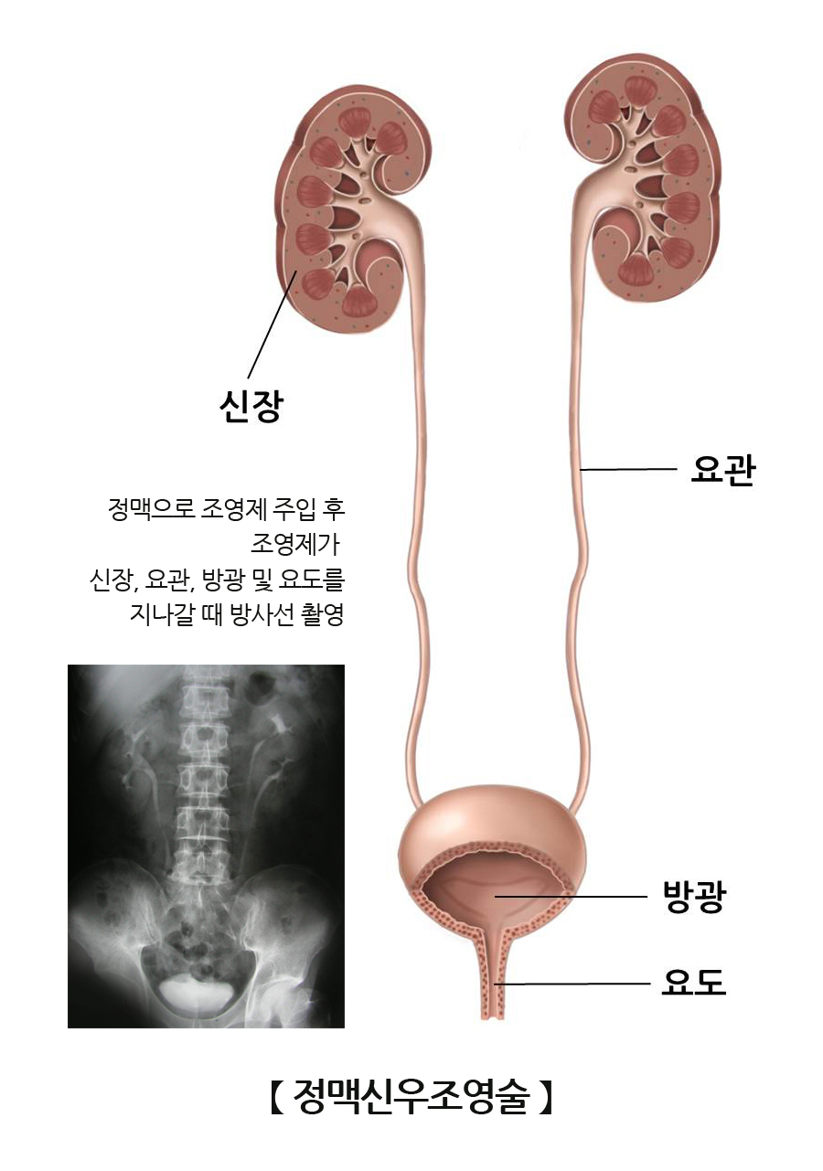 정맥 신우조영술