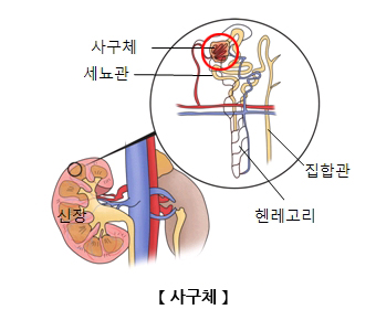 사구체